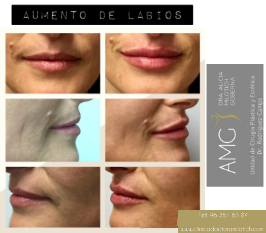 DraMilotich's tweet photo. Aumento de labios y rejuvenecimiento labial. Arrugas peribucales.
https://t.co/JE3cxNCCwG
#RejuvenecimientoFacial #AcidoHialuronico #Botox #HilosSilhouette #MedicinaEstetica #Valencia
#prophilo #Azzalure #EsteticaMasculina
#Ojeras #peelings #manchassolares #BotoxValencia https://t.co/kiJNYfIPg4