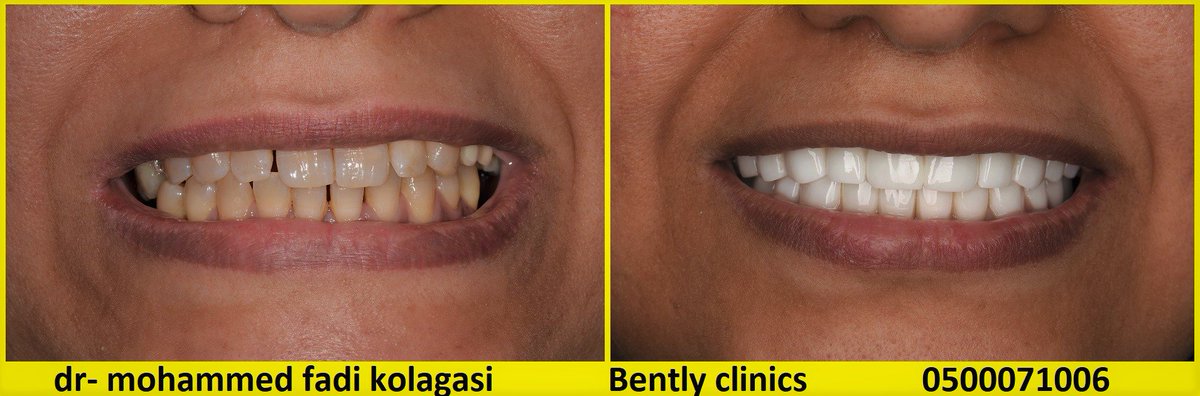 #ابتسامة_هوليود #ابتسامة #زركون #دكتور_اسنان_جدة #تركيبات_زركون #تركيبات_اللافا #عيادات_جدة #تجميل_اسنان #أسنان #مراكز_اسنان_جدة_مكه #عدسات_فينير #عدسات_لومينير #تجميل_جدة #ليزر #veneer #lumineer