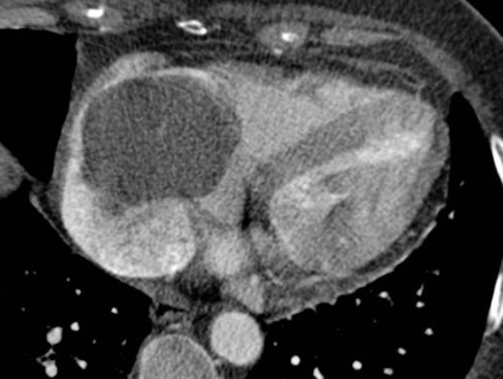 francisdeng's tweet photo. The most common cardiac… 
Mass: thrombus 
Malignancy: metastases 
Primary malignancy: angiosarcoma 
Benign tumor in adults: myxoma

-rapid #CVrad case review by @BPLittle @MGHImaging at #AUR19

(image: atrial myxoma, courtesy @frankgaillard, @Radiopaedia, rID:8544) https://t.co/eA4GfaBvgm