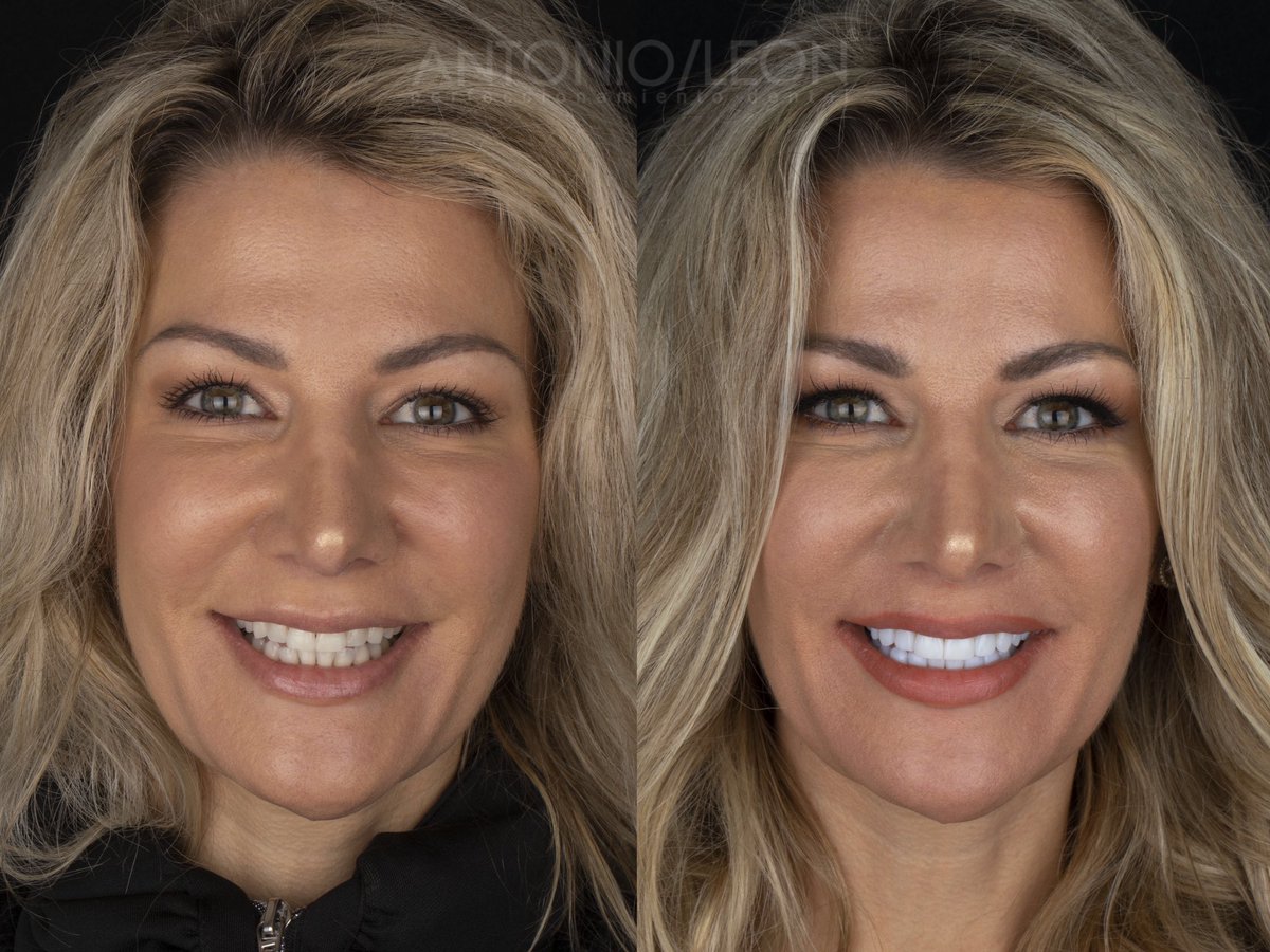DRANTONIOLEON's tweet photo. El perfeccionamiento dental se ha convertido en un gran protagonista del rejuvenecimiento facial.
.
.
.
#veneers #dentalveneers #dentalcases #antesydespues #drantonioleon #bestsmile #veneers_smile #perfeccionamientodental #rejuvenecimientofacial #smiledesigner #smiledesing https://t.co/tfcoYUayAq