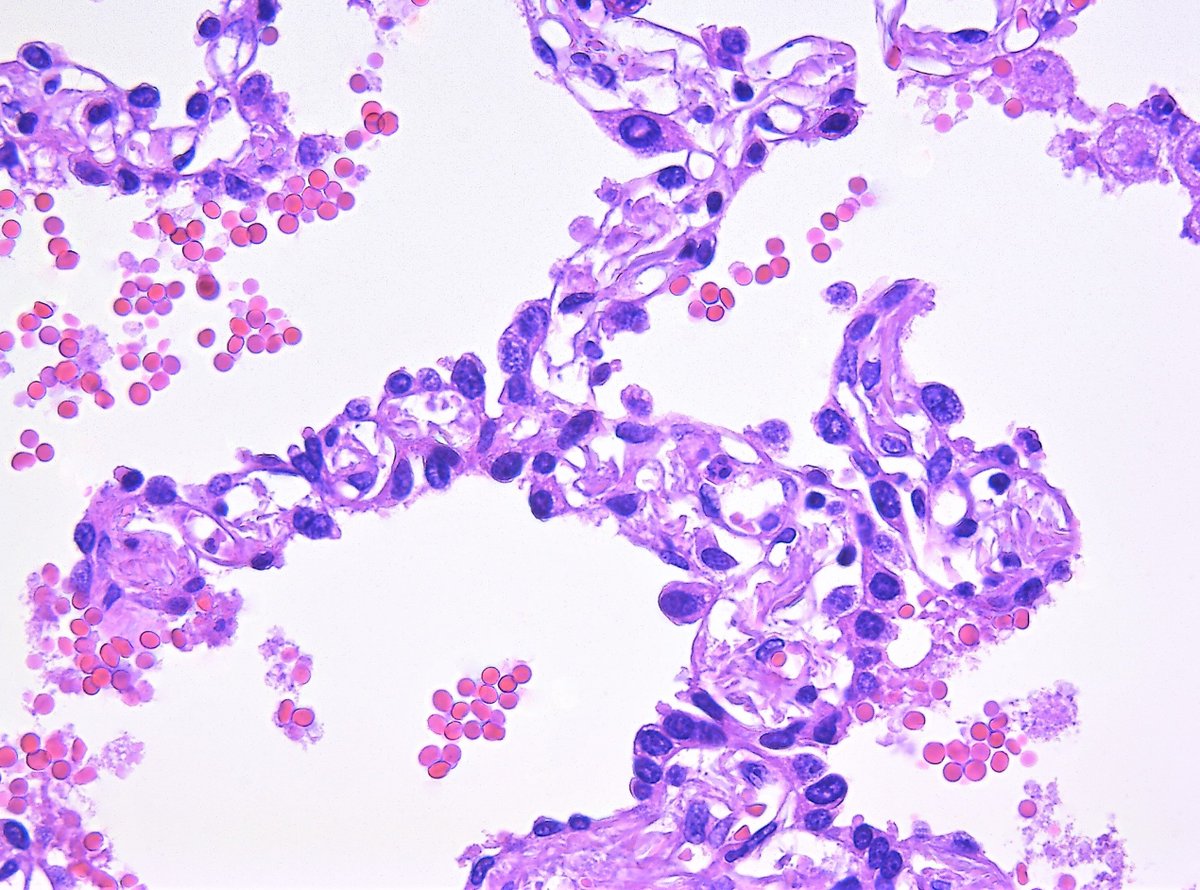 Patholwalker's tweet photo. Adenocarcinoma in situ vs Atypical adenomatous hyperplasia…? Size: 2.3x2.1mm. Lung, resection. #pathology #pulmopath https://t.co/qNA2UVJFm7