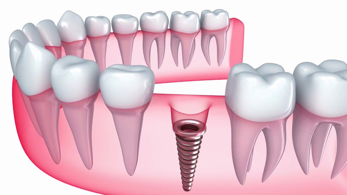 gregorywskeens's tweet photo. Want to Know More About #dental Implants?
Click Here... https://t.co/P9J4h3yu2U
•
•
•
•
•
#oralhealth #dentists #health #healthyliving #implants #technology #cool #encinitas #skeens #encinitasdentist #localdentist #hygiene #hygienist #dentistry #dentist #teeth #dentalhygiene https://t.co/PWFBdRVNuK