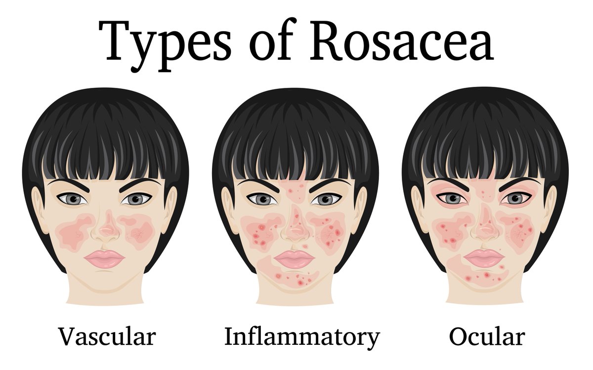 CranleyClinic's tweet photo. This month is Rosacea Awareness Month. Approximately one in every 600 people in the UK are diagnosed with rosacea, ie 10% of the population. The cause is often genetic. You may have face redness and/or acne like spots and thread veins. https://t.co/cdTdvI24kp https://t.co/fqrDSM3zGP