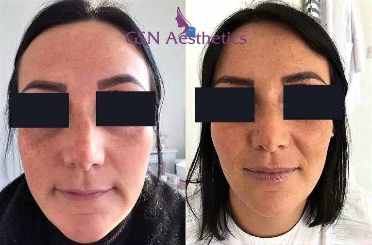 A 15 minute rhinoplasty! 🙌👃 A subtle procedure that has completely straightened our clients nose. 😍 #nonsurgicalnosejob
