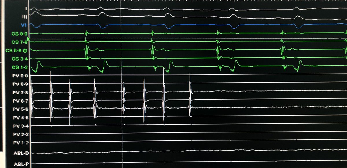 Roderick Tung (@drrodericktung) on Twitter photo Day 3-Guangzhou. Nice example of SVC fibrillation after prior PVI, before and after isolation. It is not clear (to me) why the firing stops shortly after isolation from a distance. Hypothesis? <a href="/narrowQRS/">JMC</a> <a href="/Dr_Santangeli/">Pasquale Santangeli</a> @andreanatalemd <a href="/LuigiDiBiaseMD/">Luigi Di Biase</a> <a href="/Ed_Gerst/">Edward Gerstenfeld</a> <a href="/DrJCheungEP/">Jim Cheung</a> Day 3-Guangzhou. Nice example of SVC fibrillation after prior PVI, before and after isolation. It is not clear (to me) why the firing stops shortly after isolation from a distance. Hypothesis? <a href="/narrowQRS/">JMC</a> <a href="/Dr_Santangeli/">Pasquale Santangeli</a> @andreanatalemd <a href="/LuigiDiBiaseMD/">Luigi Di Biase</a> <a href="/Ed_Gerst/">Edward Gerstenfeld</a> <a href="/DrJCheungEP/">Jim Cheung</a>