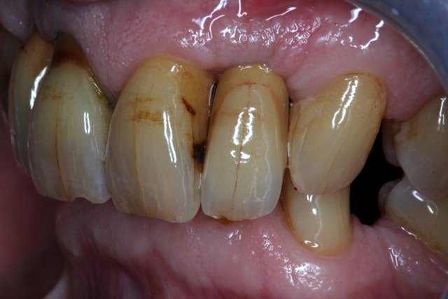 Precision1982's tweet photo. Lateral implant crowns made by @Precision1982. Photos courtesy of Dr Tariq Idrees. #cosmeticdentistry #dentalimplants #dentallaboratory #dentistry #precisiondentalstudio #smile #crowns #teeth #shadematch #privatedentistry #pbc #dentalart https://t.co/NgcRMwdCGJ