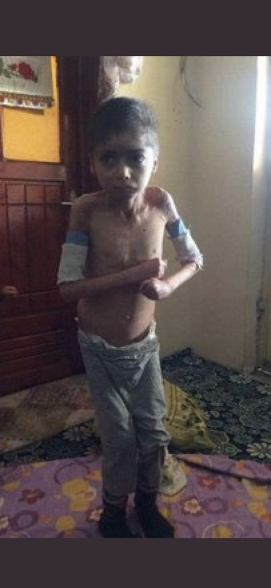 NAGiHANKARADERE's tweet photo. Doğuştan epidermolizis bülloza hastası İki Kardeş Lütfen Yetkililere ulaştıralım 🙏😞
Anne Hamdie Tel0507 723 7288  ( Paylaşın ) https://t.co/sR0FIroaoK