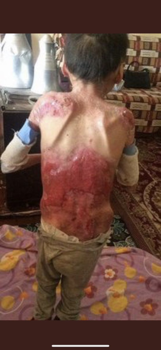 NAGiHANKARADERE's tweet photo. Doğuştan epidermolizis bülloza hastası İki Kardeş Lütfen Yetkililere ulaştıralım 🙏😞
Anne Hamdie Tel0507 723 7288  ( Paylaşın ) https://t.co/sR0FIroaoK