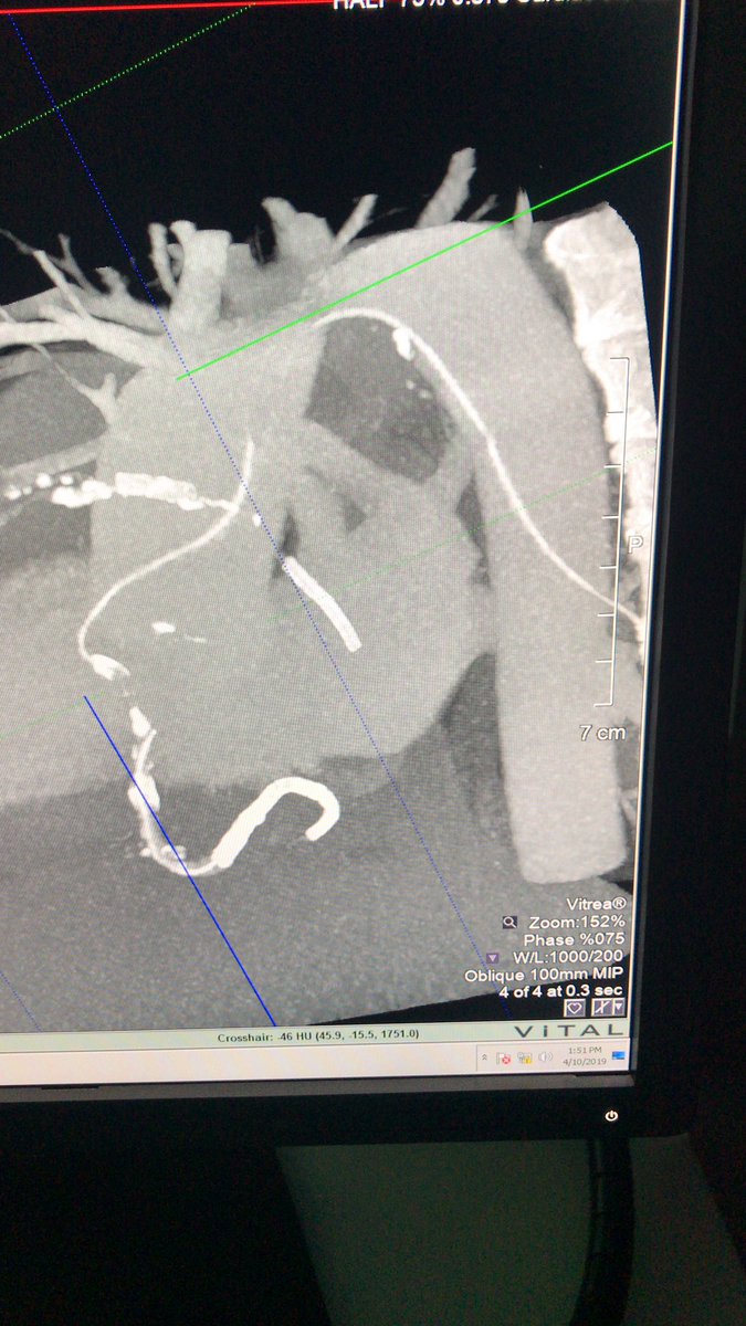 amitbha64365447's tweet image. Any guesses about what’s going on with this patient #WHYCCT