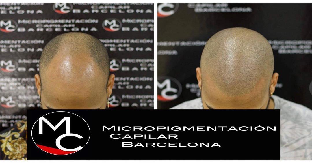 micropigcapibcn's tweet photo. Actualizamos con una fotografía del antes y después de un tratamiento de Micropigmentación Capilar.
¡Tu satisfacción es nuestro mejor trabajo!
Para más info:
e-mail: micropigmentacioncapilarbcn@gmail.com
Whats: 600.63.46.16
#micropigmentacioncapilar #MCBarcelona #sinfiltros https://t.co/bLSywijjo9