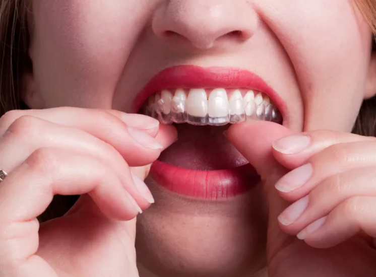 FFOrthodontie's tweet photo. La mode des #aligneurs fait actuellement le #buzz sur les réseaux sociaux et auprès de certains #patients qui peuvent les percevoir comme un remède miracle. La @FFOrthodontie rappelle l'importance du #diagnostic #orthodontique et du suivi #médical -> https://t.co/aIvTQ2943S https://t.co/17uMNnckUH