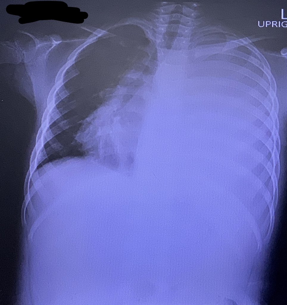 ปวดท้องก็เป็นอาการของ pneumonia ได้ 
- lower lobe pneumonia ที่จะมี refer pain มาเป็นอาการปวดท้องส่วนบน
- ผู้ป่วยเข้าใจว่า pleuritic chest pain เป็นอาการปวดท้อง 

ดังนั้นถ้าผู้ป่วยมาด้วยอาการปวดท้อง ควรตรวจร่างกายทางระบบหายใจ ฟังปอดด้วย 

และพิจารณาสั่ง film chest xray ด้วยนะ