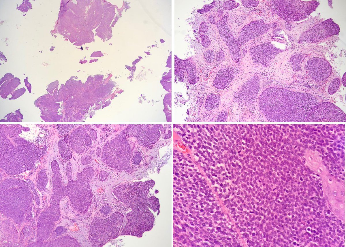 Porocarcinoma: Invasive nests and anastomosing cords of basaloid cells with focal squamous differentiation with numerous mitotic figures. Top differential diagnosis: Poroma, hidradenoma and hidradenocarcinomas, SCC, BCC.