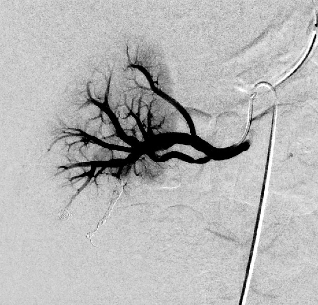 Huge renal PSA 9 days post pNX w/ persistent hematuria.  Coiling starts in the outflow!  Back door --&gt; Front door or risk continued bleeding! Double team w/ <a href="/cek_VIR/">Christopher Kim</a> #ImpeccableCoilTechnique #SoMuchKidneyLeft! #iRad <a href="/AMI_Vascular/">Vascular Institute of Atlantic Medical Imaging</a> @AMIRadiology @MdPetruzzi <a href="/AlexCVIR/">Alexandria CVIR</a> @ABrandisVIR
