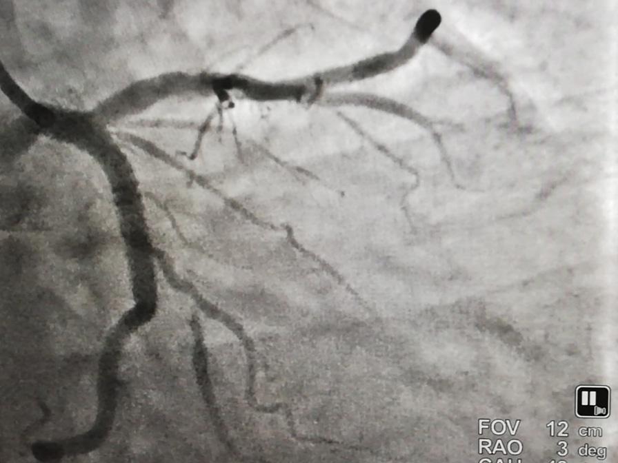 Thahei's tweet photo. ~When your heart skipped a beat... 
And you know your heart is in safe hands...
AlhamdhuLillahi for everything
Blessings come in different ways~
#23April19 #Angiogram #Angioplasty #LCX 
#MyStrengthTookCareOfMyWeakness https://t.co/ftn7VQPJED