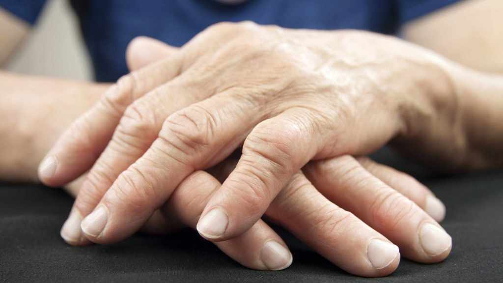 DrWangG's tweet photo. Complications of Rheumatoid Arthritis. https://t.co/f9GXIdowfm https://t.co/6lWeimHRrN