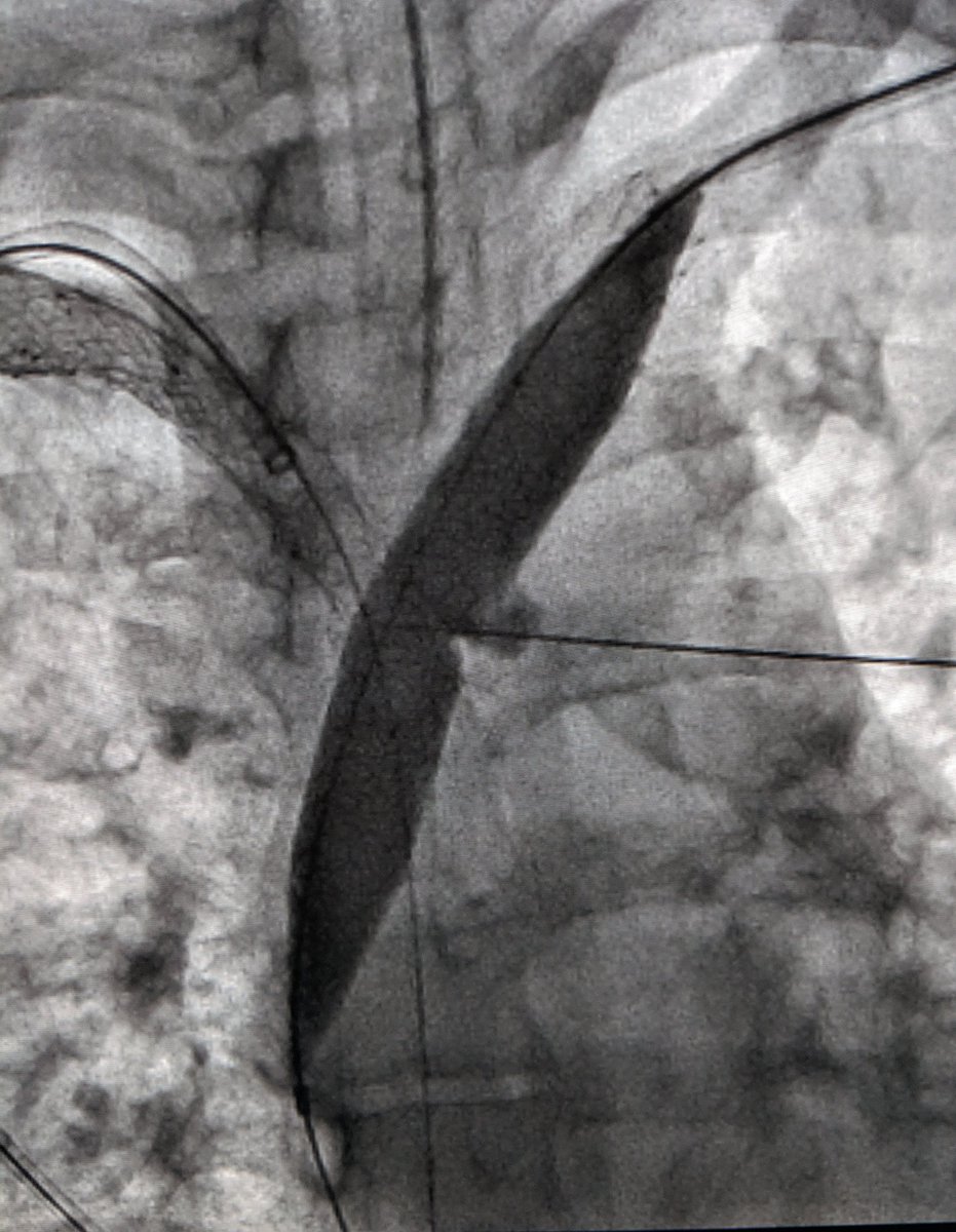 LessneVIR's tweet photo. Pt w venous obstructive sx. Chronically occluded left BC vein jailed by 8 yo right SVC stent (#OSH, but really this time). 30g CTO wire to cross, balloon interstices (which ruptured 14 mm Atlas BTW) and restore flow #IRad @CLTRadiology @SIRspecialists https://t.co/Jo05LHRdsV