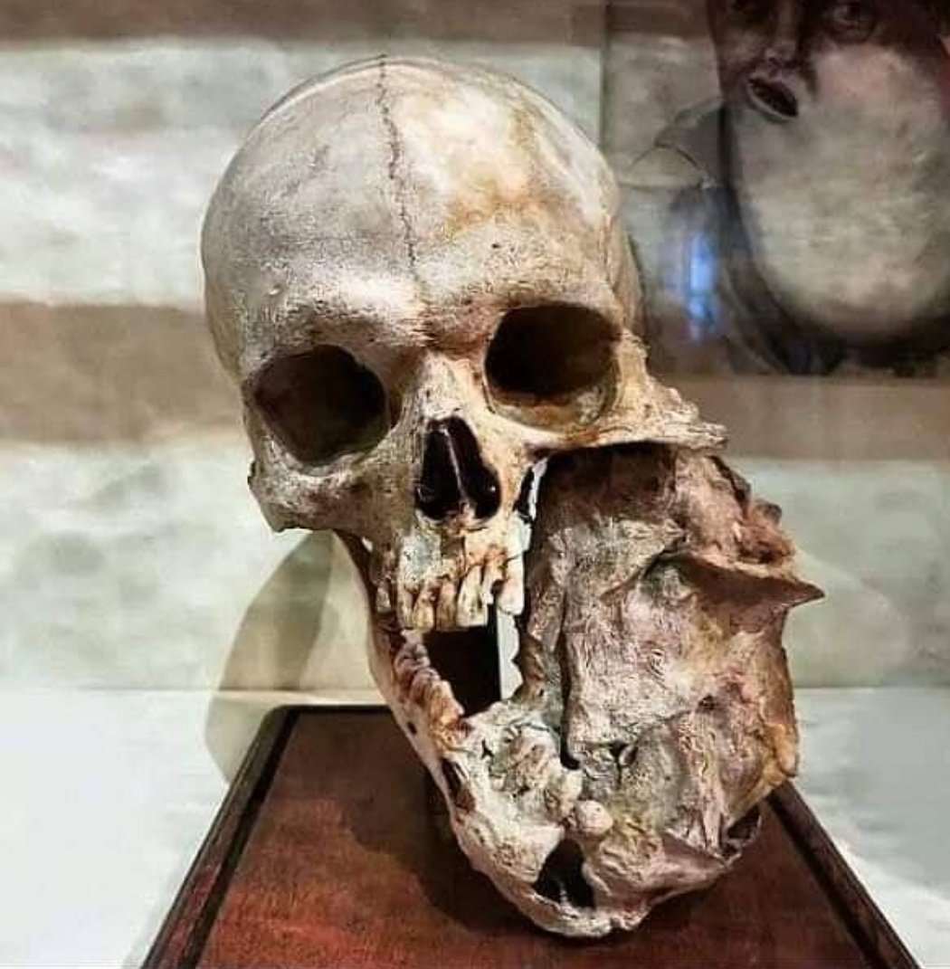 Cráneo con tumor mandibular