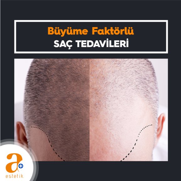 AplusLazer's tweet photo. Sonuçları 8-12 hafta içinde ortaya çıkan Büyüme Faktörlü Saç Tedavileri ile tanışın. 

Bu tedavi yöntemi ile en iyi sonuç için iki kür kombine edilir. Yöntem ile saç derisi ve foliküller beslenirken sağlıklı bir saç büyüme döngüsü sağlanır. https://t.co/d9X6qcjlKy