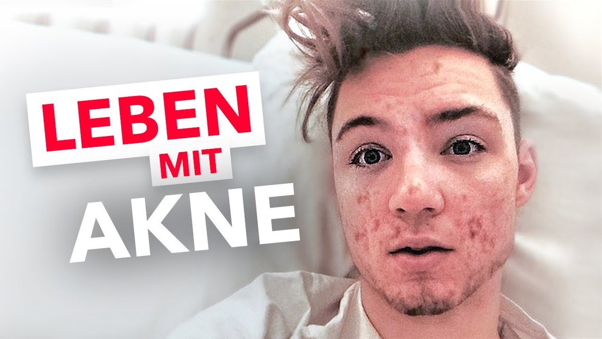 DieLochisUpdate's tweet photo. Mein Leben mit AKNE / PICKEL 😣 [Realtalk]: https://t.co/LgtsMOZRi0 von @DieLochis #DieLochis https://t.co/WpRyK4TX2H