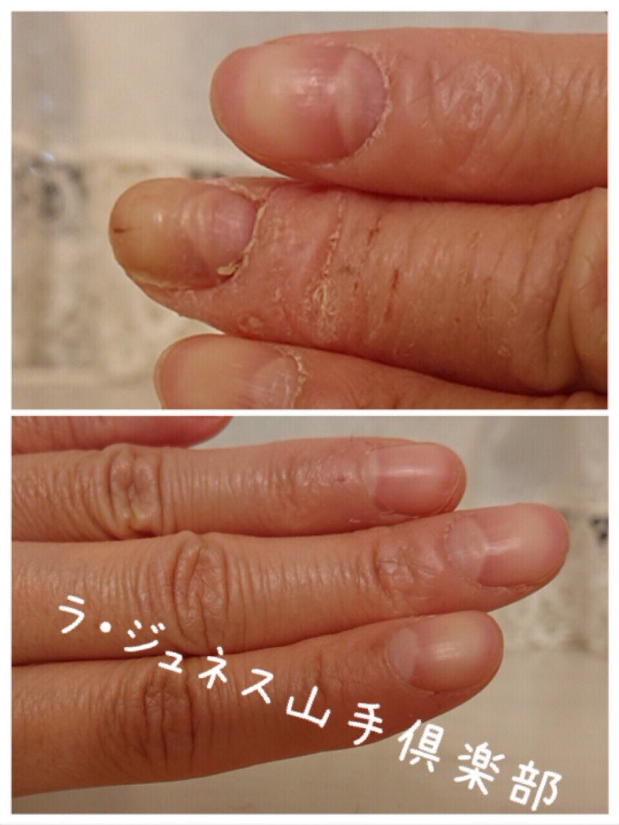 爪の悩み 爪の悩み