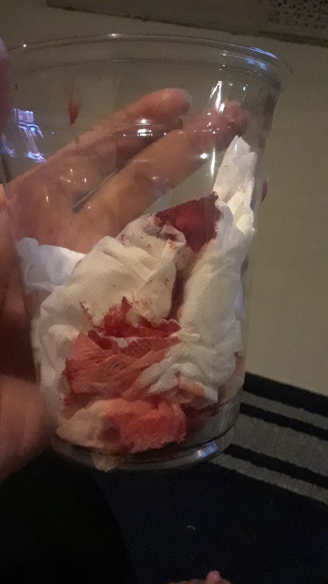 msrlw's tweet photo. Utterly ridiculous! My first ever #nosebleed caused by #DirectedEnergyWeapons aka #DEWs aka #ElectromagneticFrequencyWeapons aka #EMFWeapons. This is #slowkillassassination! Absolutely! #TargetedIndividuals The folks who caused this speak &amp; smile in my face each day! #Hellbound https://t.co/7JOoZ8BCcj