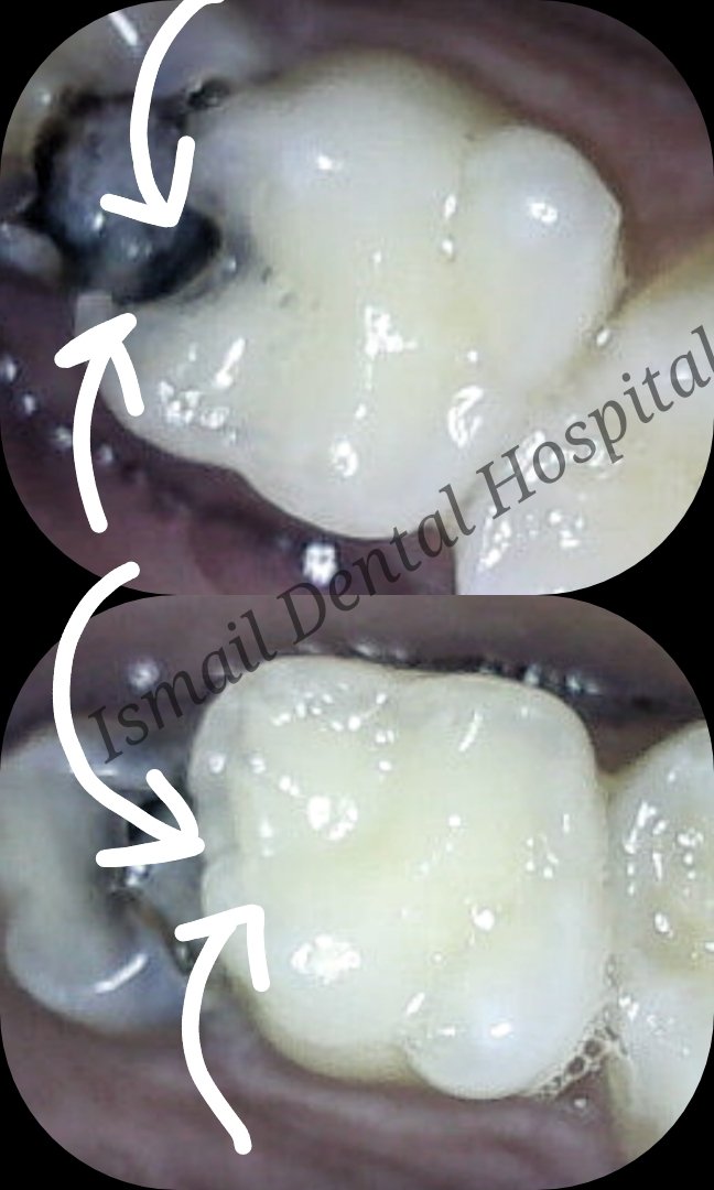 IDH_JAUNPUR's tweet photo. जब ऐसे दांत बचाई जा सकते हैं तो फिर इन को निकलवाना क्यों???
#dentalfilling
#savetooth https://t.co/rONaNkg4PC