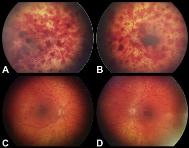 Fundoscopic examination to look for retinal hemorrhages is an essential step when there's concern for #ChildAbuse. @UniklinikBonn #ChildAbusePediatrician #Ophtalmology bit.ly/2TV3Qud