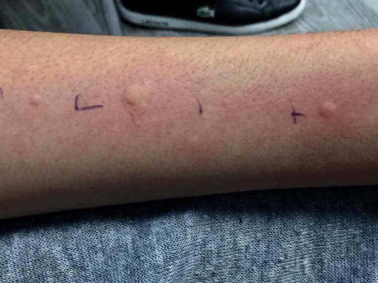 jdeboran's tweet photo. My son (PN IgE >100) completed updosing phase of peanut OIT in Oct 2017. Since then he’s eaten 2 peanuts daily without issue!

His skin prick tests:
6 months in maintenance - wheal size 11 mm
18 months in maintenance - wheal size 6 mm
#oitworks
Pics &amp; PHI shared with permission https://t.co/zYcfKx5GHC