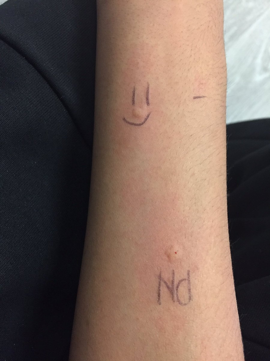 jdeboran's tweet photo. My son (PN IgE >100) completed updosing phase of peanut OIT in Oct 2017. Since then he’s eaten 2 peanuts daily without issue!

His skin prick tests:
6 months in maintenance - wheal size 11 mm
18 months in maintenance - wheal size 6 mm
#oitworks
Pics &amp; PHI shared with permission https://t.co/zYcfKx5GHC