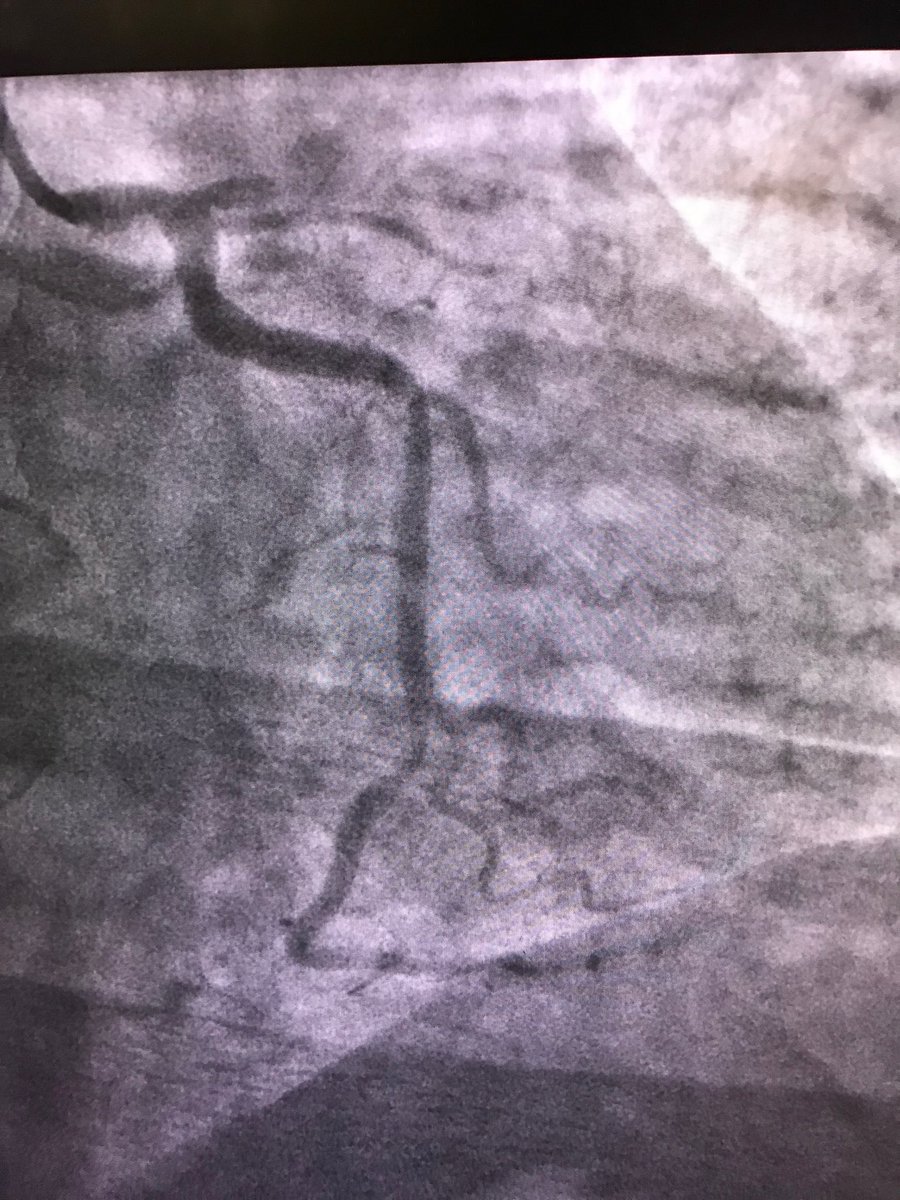 istentem's tweet image. #safefemoral #protectedpci 62 m anterior stemi ivus guided into left main . Ef 50% at d/c