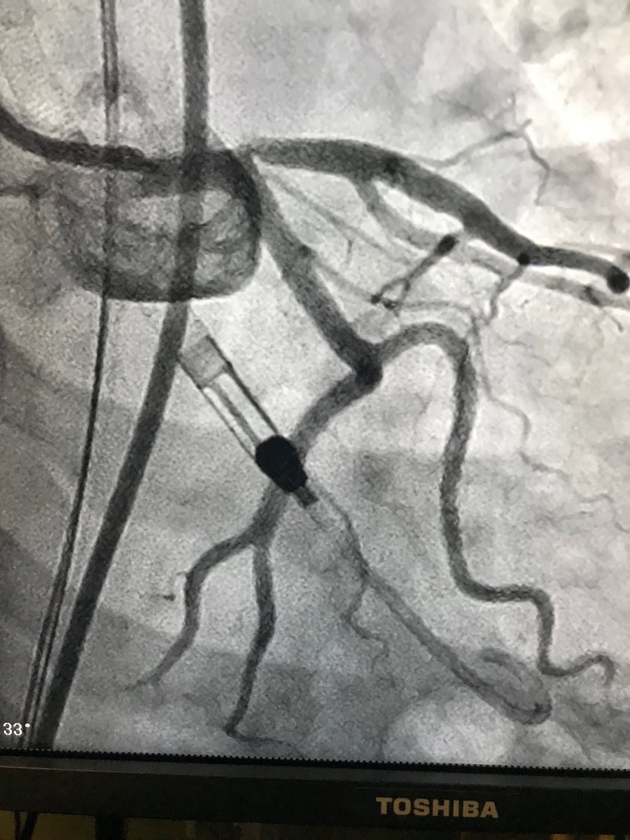istentem's tweet image. #safefemoral#protectedpci#impella 45f angina, +nuke,Nl rca and EF ivus guided 4x15 des , pot to 5 .preclose .#impella out in lab