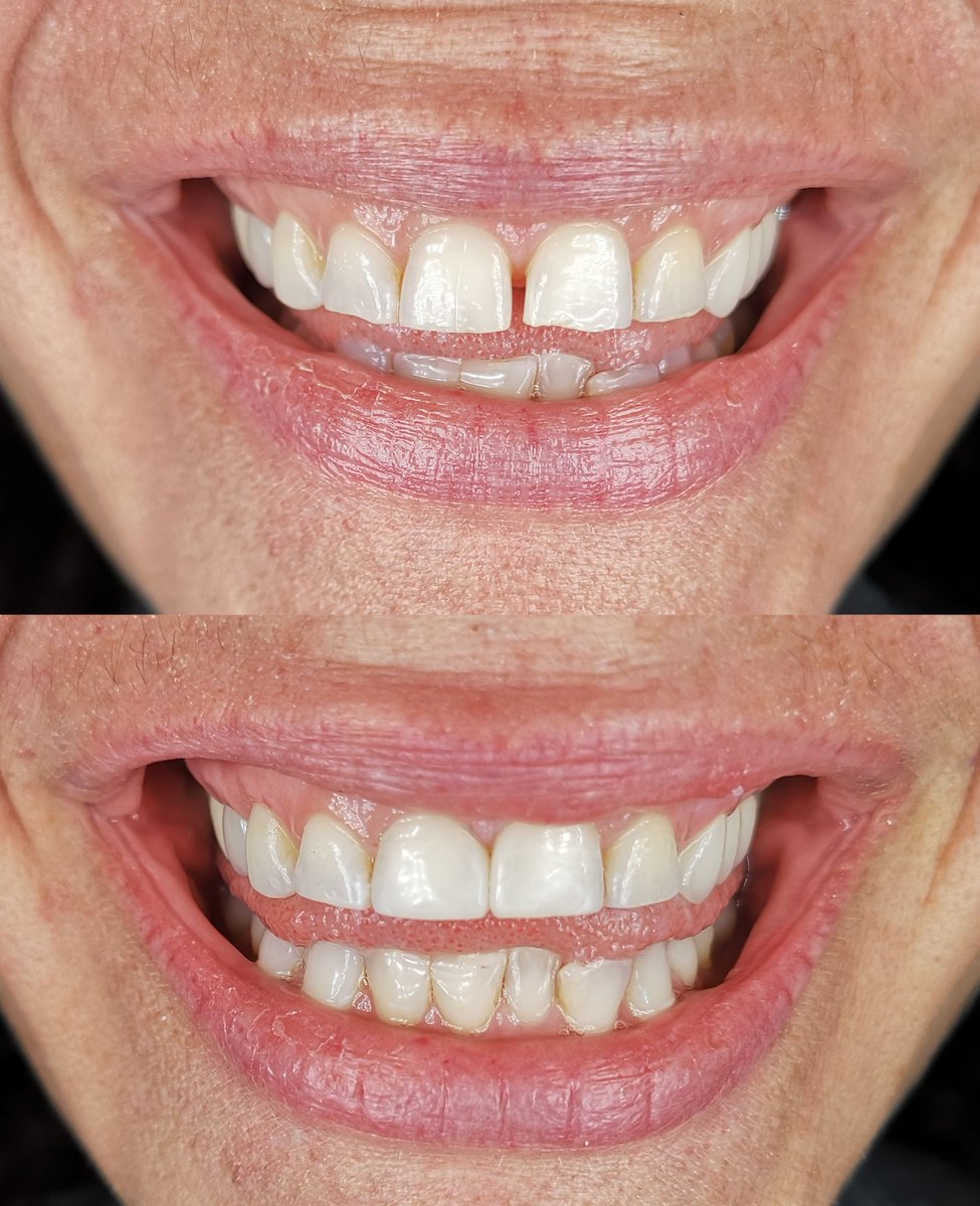 AusArtDental's tweet image. Another gap and chipped teeth conservatively and cosmetically improved with the Bioclear Method and Cosmetic Shaping! #bioclearmethod #bioclear #cosmeticdentistry #cosmeticdentist # austindentist #austincosmeticdentist #smiles #gap #conservativedentistry