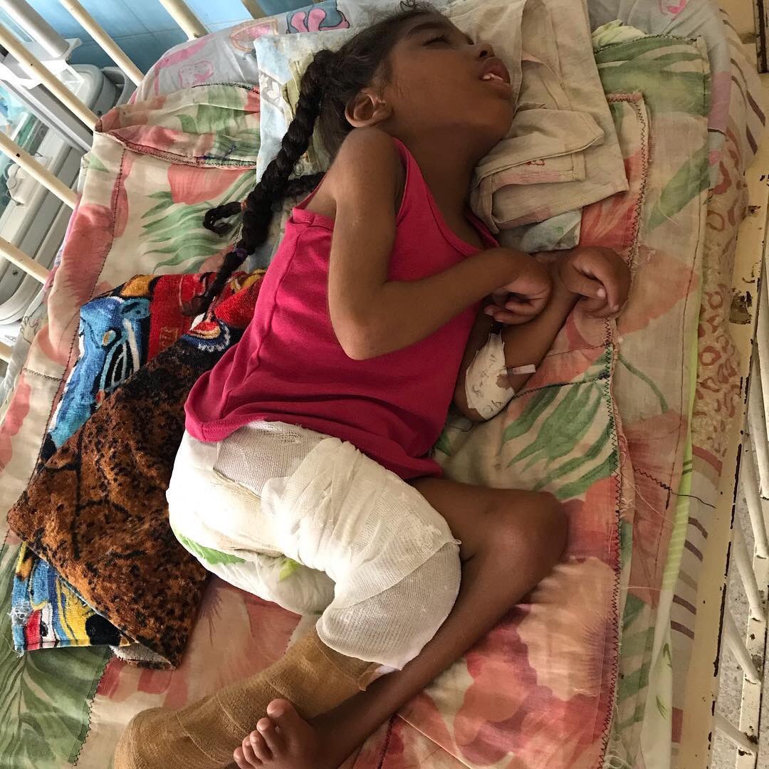 cristiancrespoj's tweet photo. Esta pequeña niña necesita de nuestra Ayuda Por Favor!!! Padece de Parálisis, Hidrocefalia  y sufrió una fractura en las piernas, Necesita 10 Yesos de 20 #URGENTE! Ayudas a "sonrisasunidasorg" en Instagram. Gracias! https://t.co/vvwB4MsLay