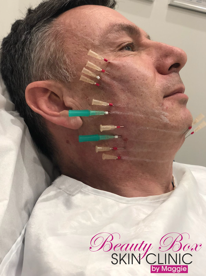 BeautyBoxMaggie's tweet photo. You can get a non-surgical face lift in 30 minutes😱

Improve the appearance of sagging cheeks, deep lines &amp; wrinkles with our simple thread lift procedure✨

Contact us on 07424716505 to book an appointment😘

#facelift #wrinkles #youthfulskin #threadlift #Essex https://t.co/wz8gKQiX2V
