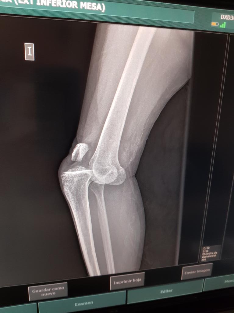 drfelipejimenez's tweet photo. Alcance en la A4, copiloto... Saltó el airbag.... Porque puñetas nos empeñamos en llevar las piernas en el salpicadero?? Luxación de rodilla con compromiso vascular. Manejamos con midazolam y ketamina https://t.co/Ijc9VPGMDp