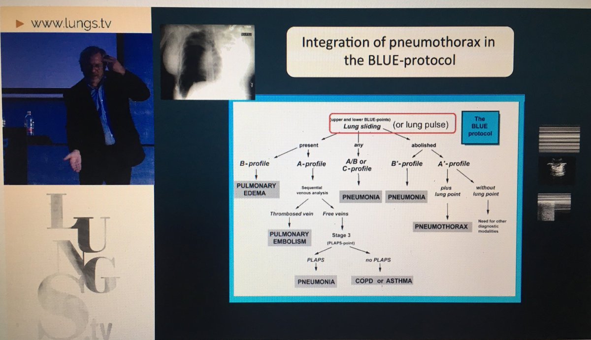 D. Lichtenstein talking about BLUE protocol on #theartoflungultrasound <a href="/LungsTv/">Lungs Tv</a> #POCUS