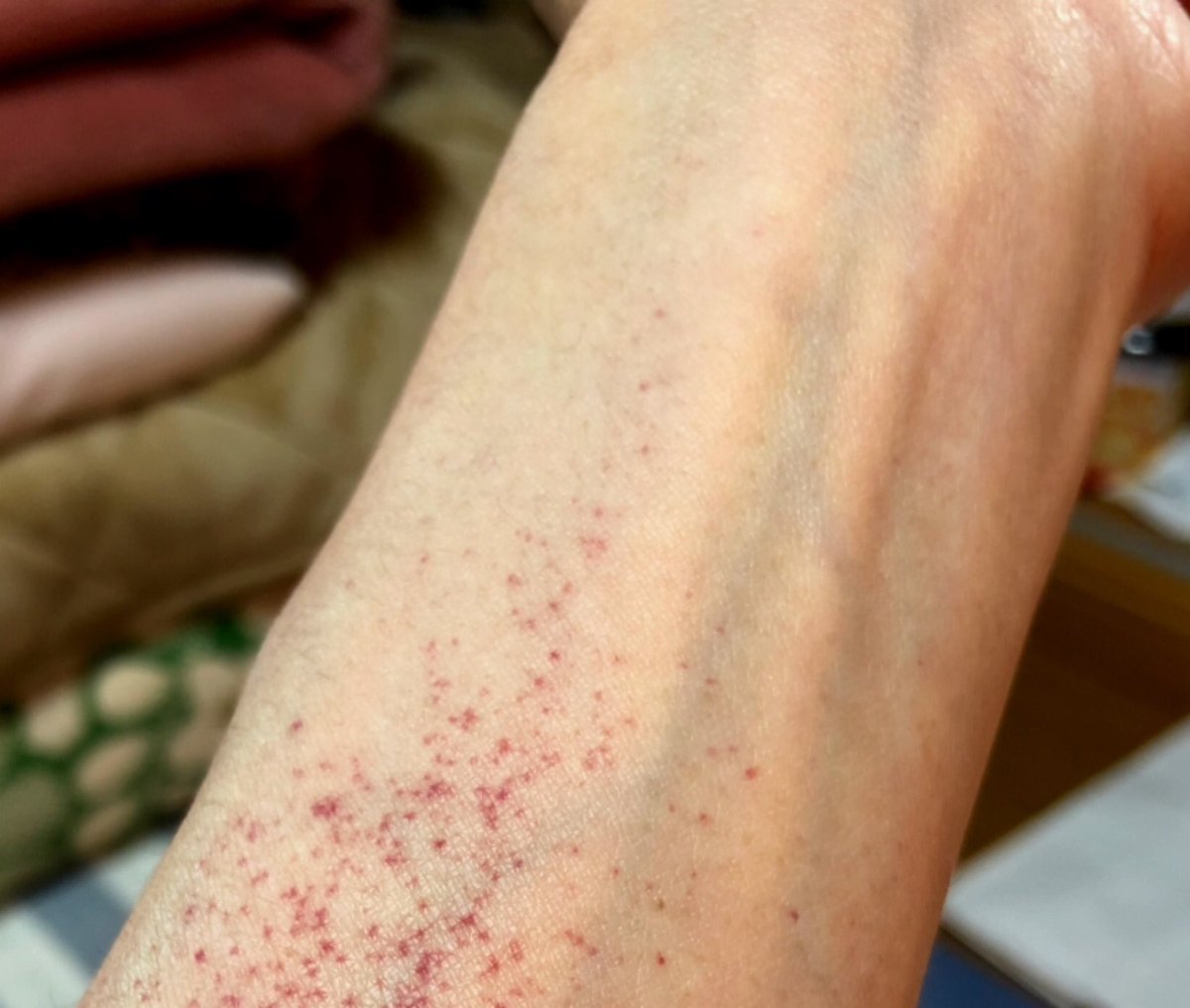 赤い 斑点 痒く ない 痒くない湿疹がお腹や腕にできる4大原因と対処法 赤い斑点やポツポツの正体とは