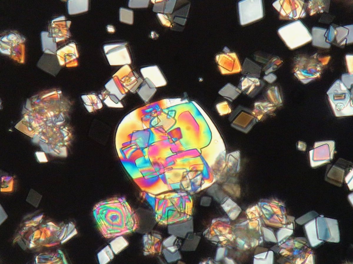JoseTesser's tweet image. #saturdaynightbeauty #uricacid #polarizedlightmicroscopy #urinesediment #urinalysis #pathart #clinicalpathology #microscopy #laboratorymedicine