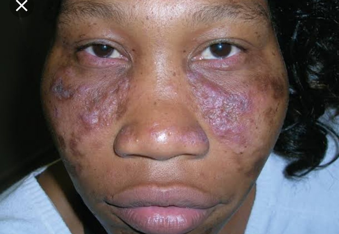 Discoid and malar rash in SLE.