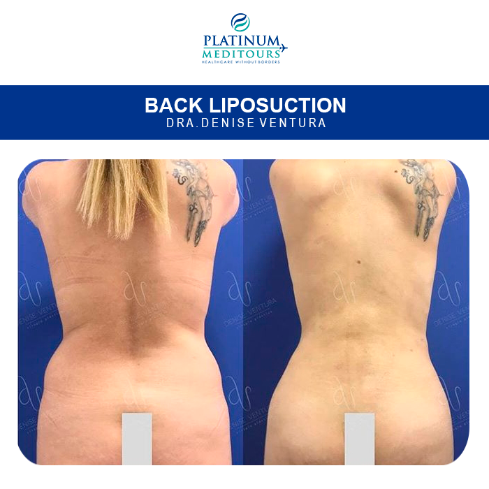 PMeditours's tweet image. Back #liposuction by Dra. Denise Ventura
Pay 20 to 50% less than in #USA
Available financing options