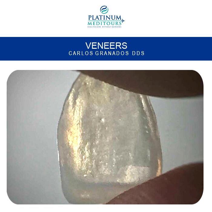 PMeditours's tweet image. ℹThere are various models and variants of #dental #veneers