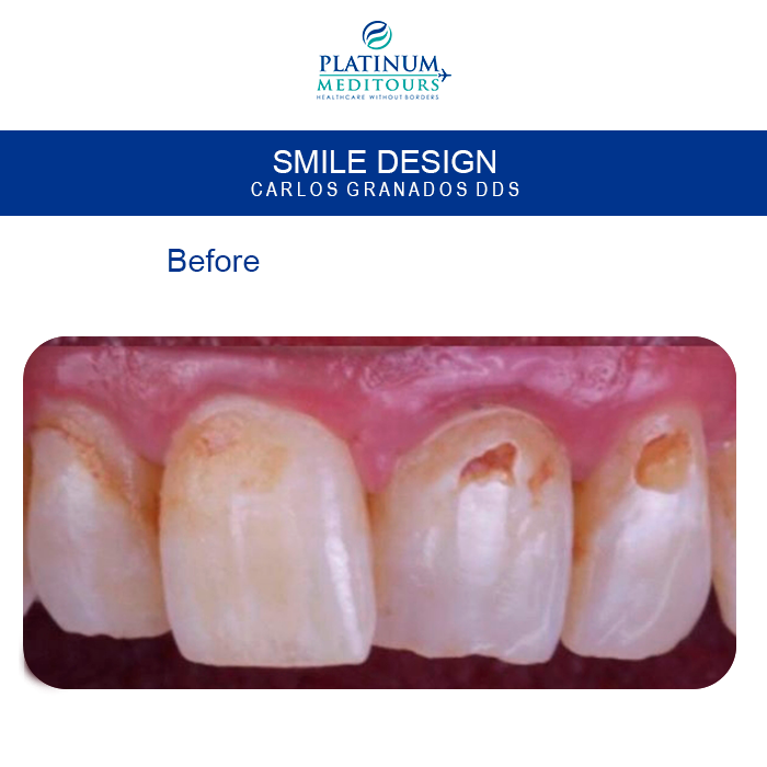 PMeditours's tweet image. #beforeandafter
♥️The perfect Smile you have always wanted… Need financing?
Get a free QUOTE NOW👇👇