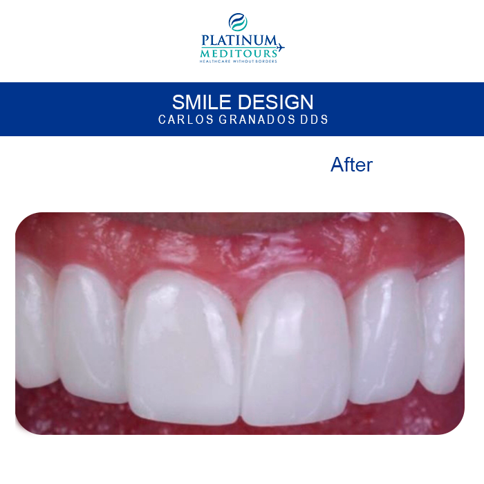 PMeditours's tweet image. #beforeandafter
♥️The perfect Smile you have always wanted… Need financing?
Get a free QUOTE NOW👇👇