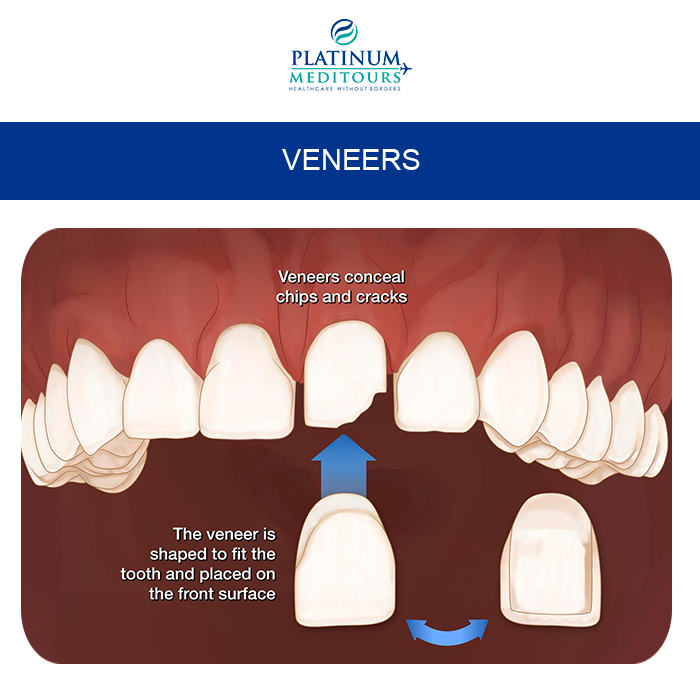 PMeditours's tweet image. #Veneers are minimally invasive dental aesthetics treatment, ideal for improving the appearance of teeth ( color, shape, size ) and improve the #smile.