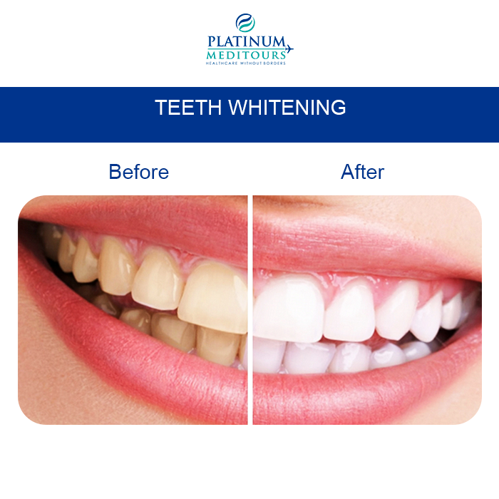 PMeditours's tweet image. #Teeth #Whitening fast &amp;amp; effective
The laser whitening treatment and unique lamps ( such as LED light ), is used to change the natural color of the teeth and make them whiter, to show off a dazzling white smile.