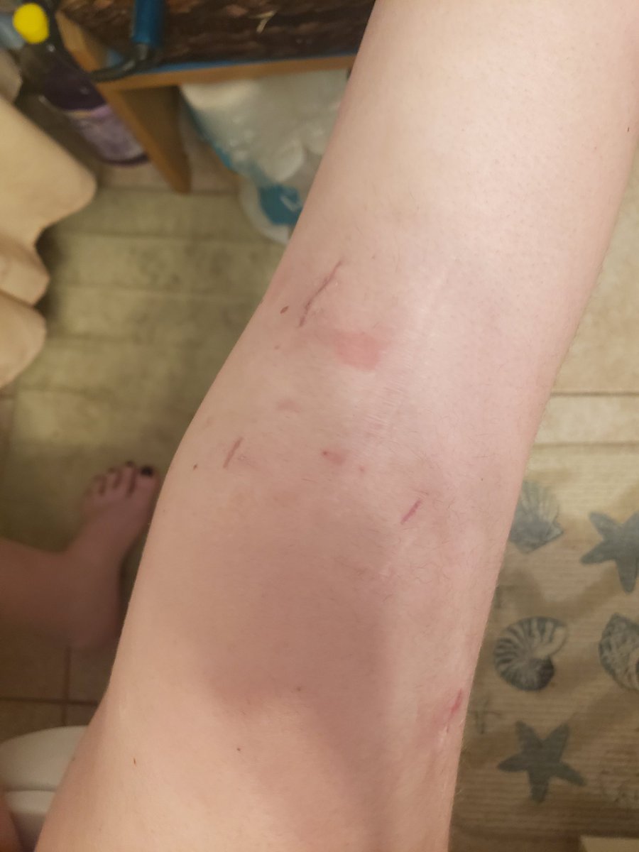 jennitha__'s tweet photo. Btw here is my deformed knee today, April 14th vs. 3 1/2 weeks ago 🤪 #ACLReplacement #IDidntEvenHave1InMyLeg #TheyHadToGiveMeOneFromAnOrganDonor 😇😇😇😇 https://t.co/Af6bFn3Cai