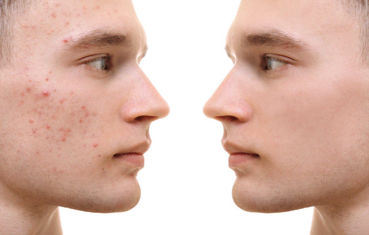 Do you suffer from blemish-prone skin? Our advanced treatments can reduce #acne and restore a clear complexion once and for all. 💉🙌 

ow.ly/CZzt30ojqQR #sidcup