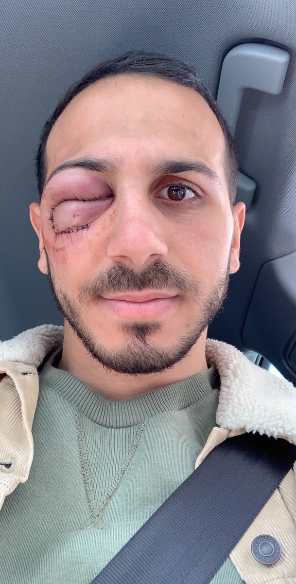 HamdaouiKylan's tweet photo. 25 points de sutures et fracture du plancher orbital, normalement sans opération on le saura dans les jours à venir🤞🏽

Un grand merci à toutes et à tous pour vos messages ! 😘 

Une grosse pensée pour Tony et félicitations à l’équipe pour la victoire à 13 contre 15 ⚡️🌸 https://t.co/a7Phv0eP1X