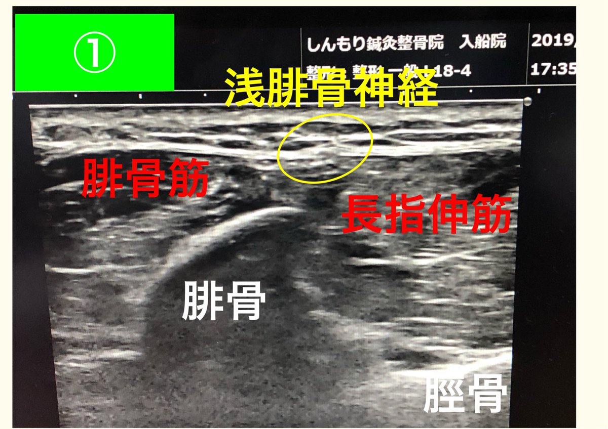 新盛淳司 鍼灸師 スポーツトレーナー メディカル 捻挫の後など足首の外くるぶしのあたりの痛みで苦しんでるアスリートは多い 浅腓骨神経の滑走性を改善すると痛みが緩和するケースを経験する ブログ なかなか消えない足首外側の痛み T Co 新盛淳司 鍼灸師 スポーツトレーナー メディカル 捻挫の後など足首の外くるぶしのあたりの痛みで苦しんでるアスリートは多い 浅腓骨神経の滑走性を改善すると痛みが緩和するケースを経験する ブログ なかなか消えない足首外側の痛み T Co